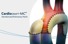 CardioGraft-MC Decellularized Pulmonary Patch