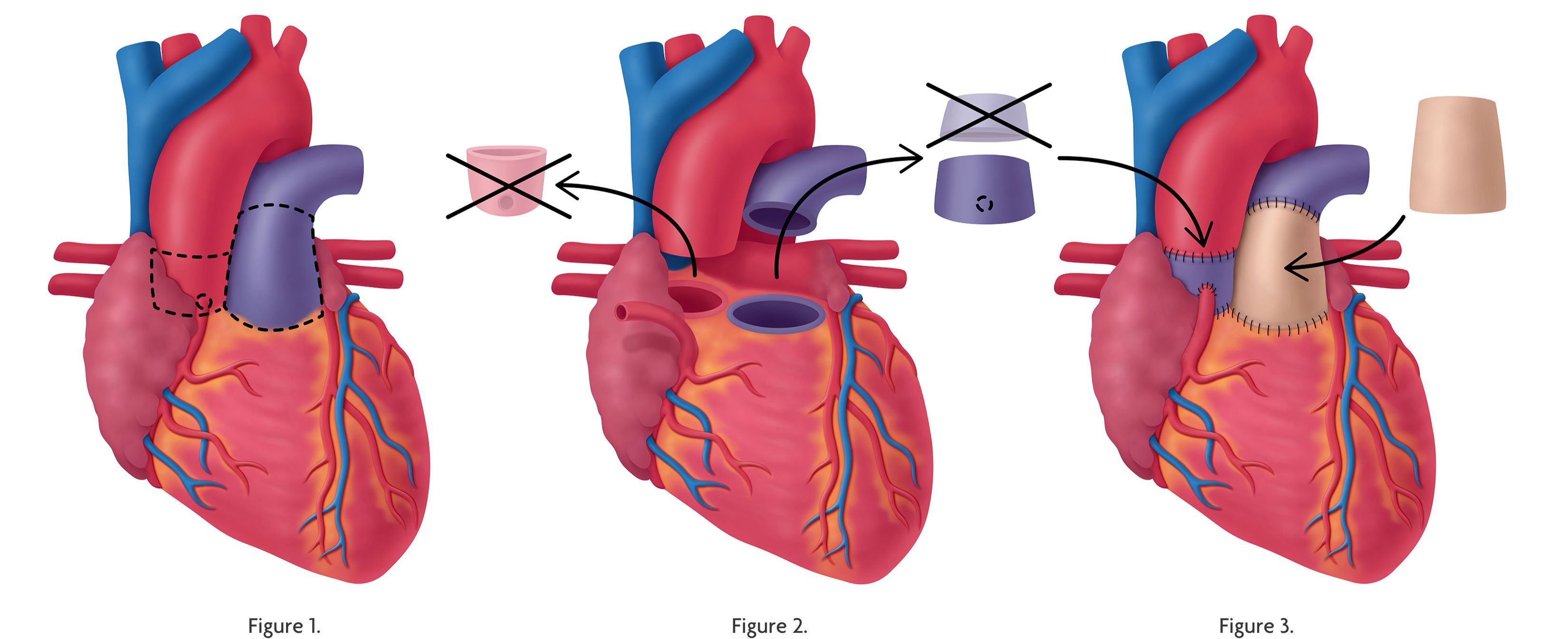 Ross Procedure